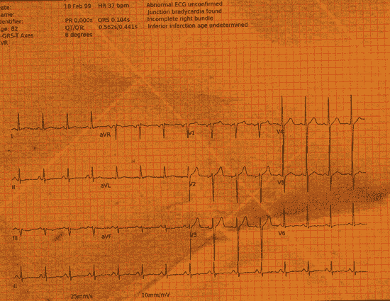 Normal ECG — PTB-XL