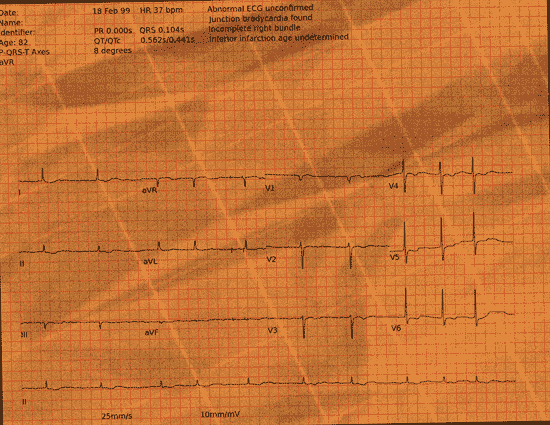 Normal ECG — PTB-XL