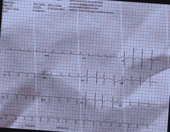 Normal ECG — PTB-XL