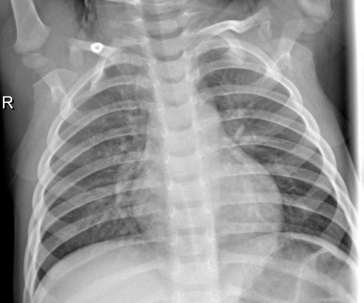 Radiografia Normal — NIH Chest X-ray14