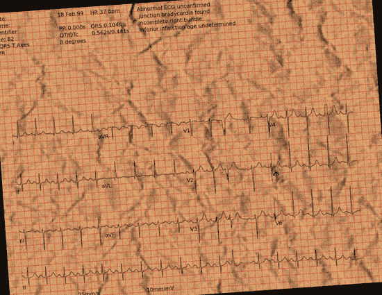Normal ECG — PTB-XL