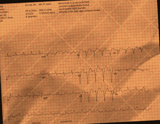 Normal ECG — PTB-XL