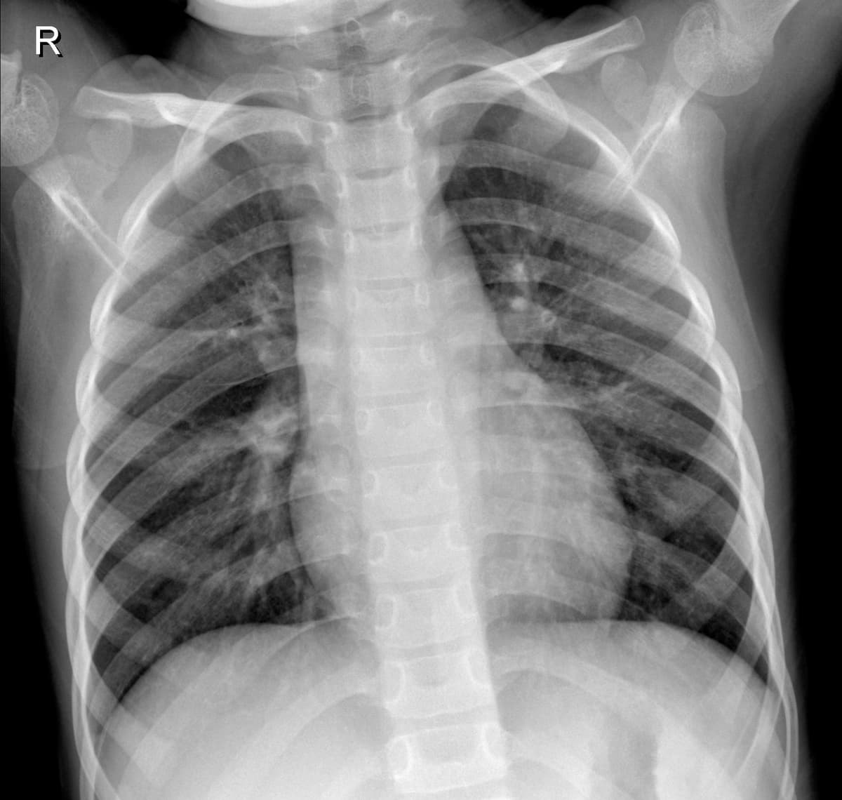 Radiografia Normal — NIH Chest X-ray14