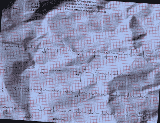 Normal ECG — PTB-XL