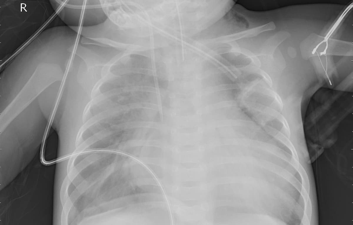 Pneumonia — NIH Chest X-ray14