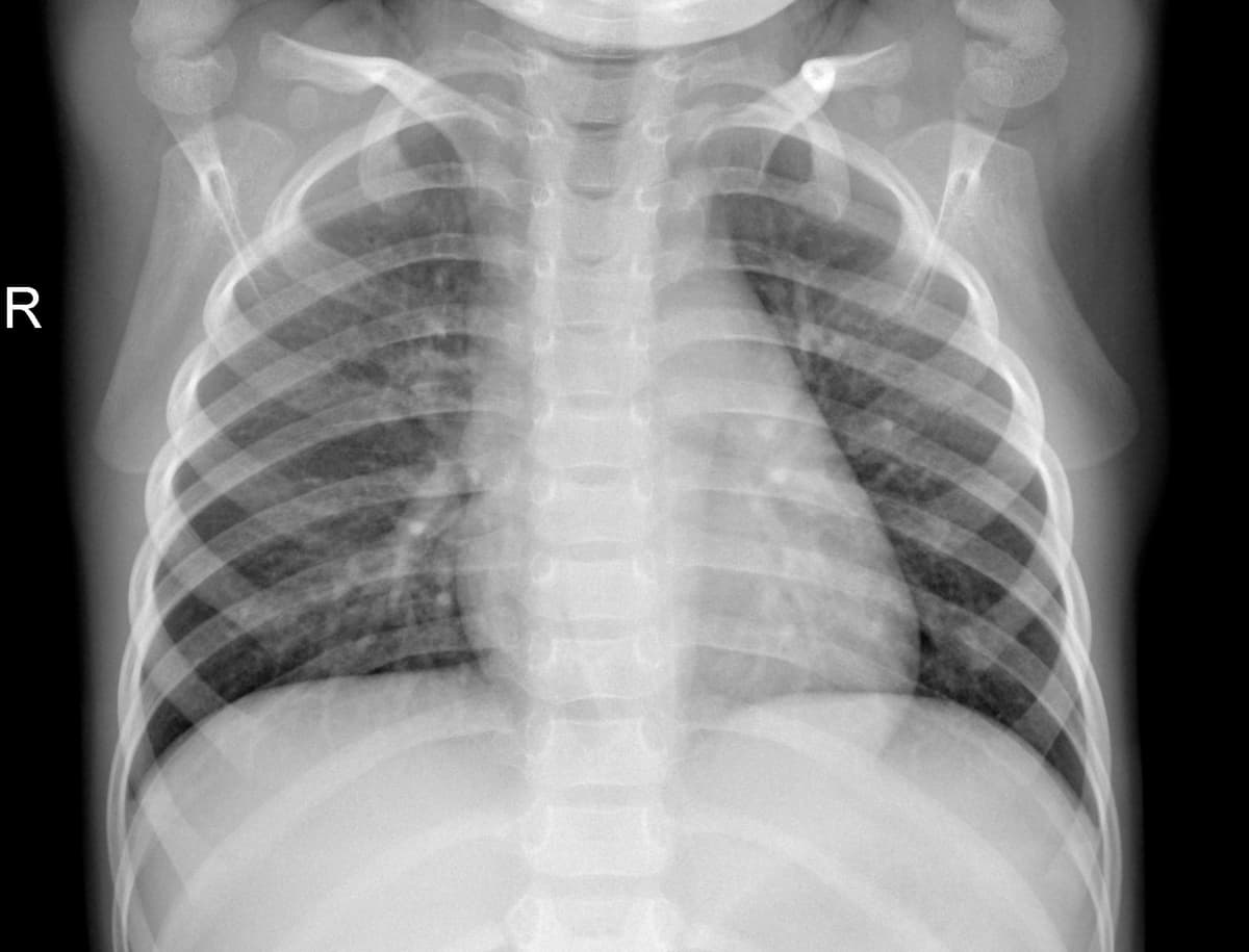 Radiografia Normal — NIH Chest X-ray14