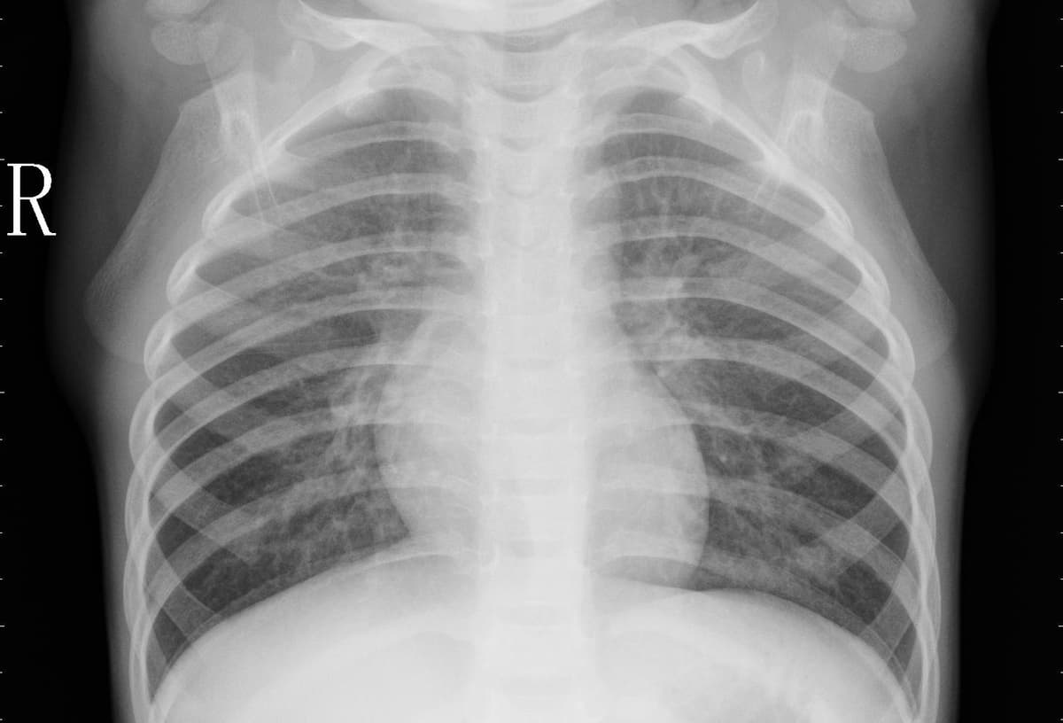 Pneumonia — NIH Chest X-ray14