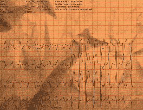 Normal ECG — PTB-XL