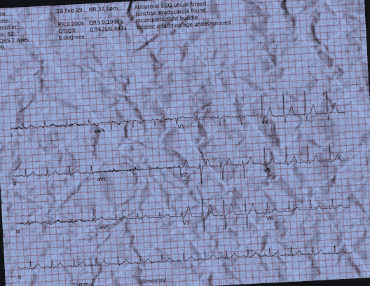 Normal ECG — PTB-XL