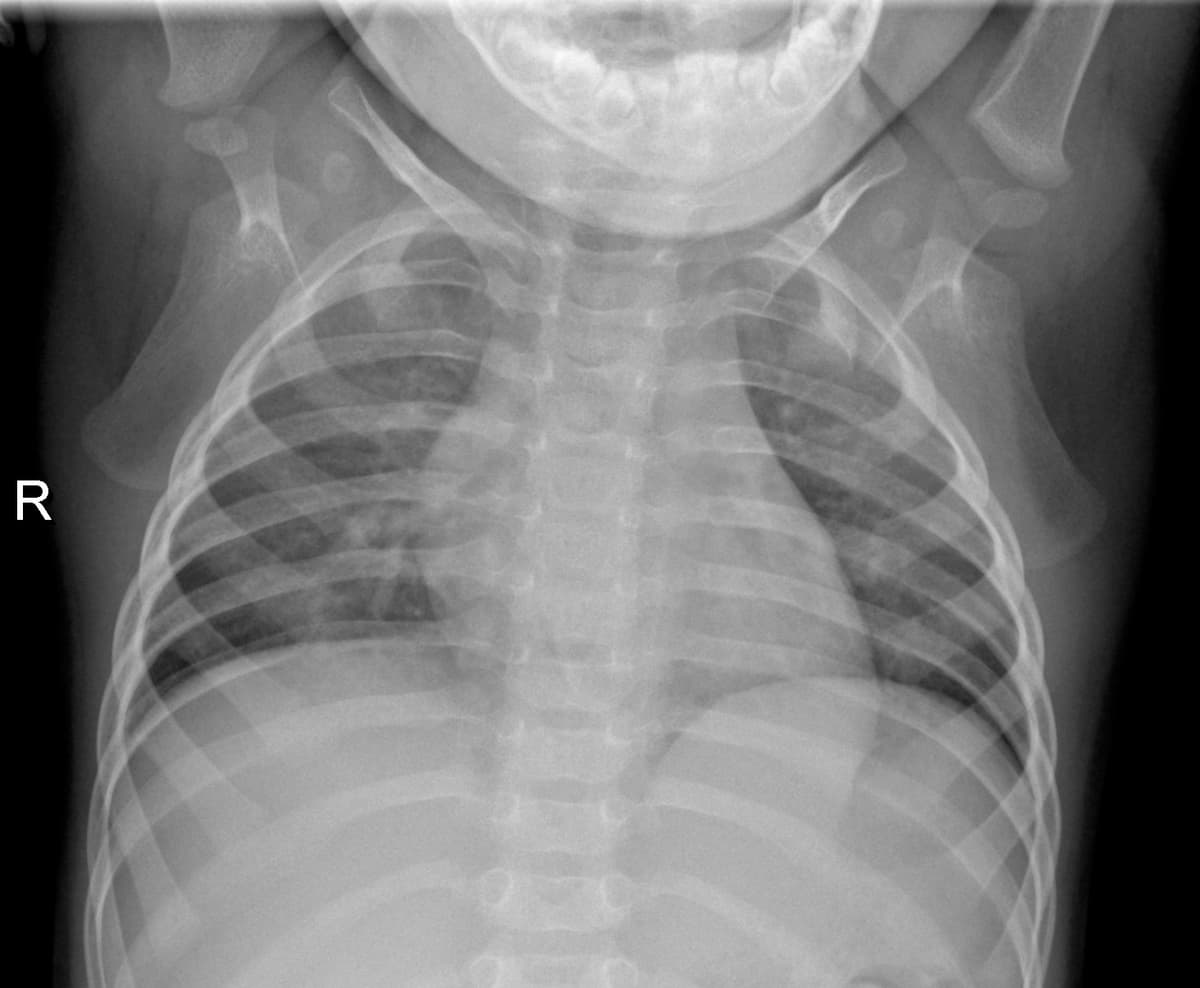 Radiografia Normal — NIH Chest X-ray14