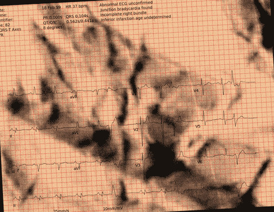 Normal ECG — PTB-XL