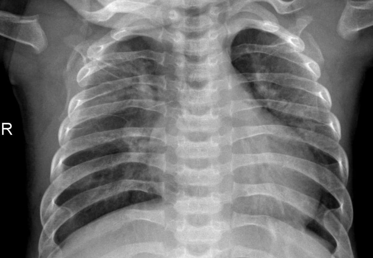 Pneumonia — NIH Chest X-ray14
