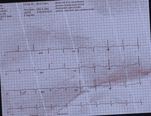 Normal ECG — PTB-XL
