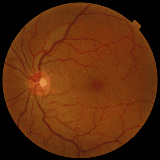 No Diabetic Retinopathy — MESSIDOR-2