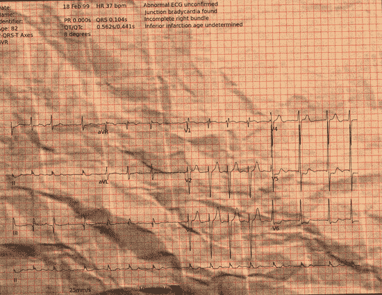 Normal ECG — PTB-XL