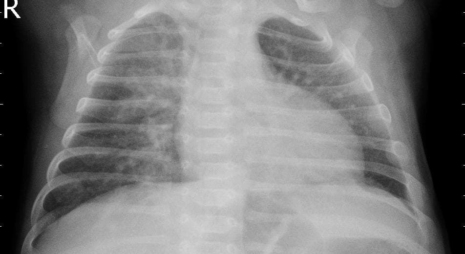 Pneumonia — NIH Chest X-ray14