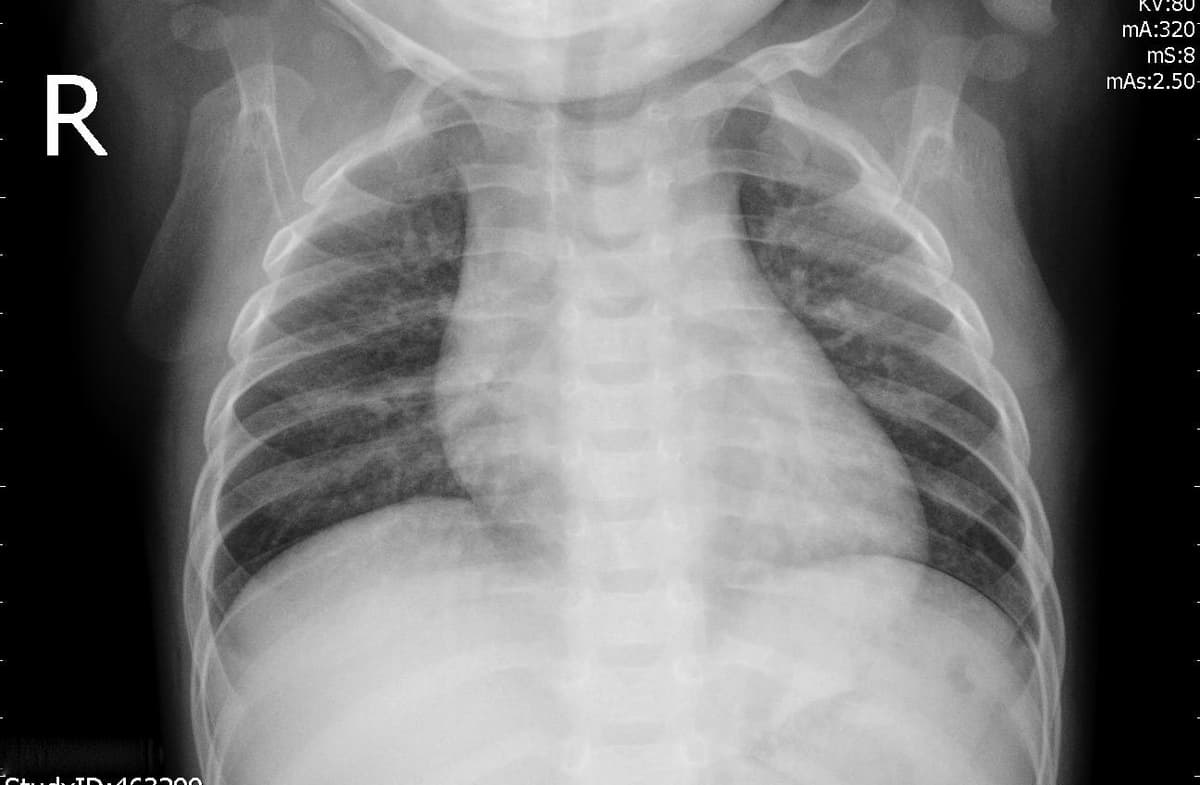 Pneumonia — NIH Chest X-ray14