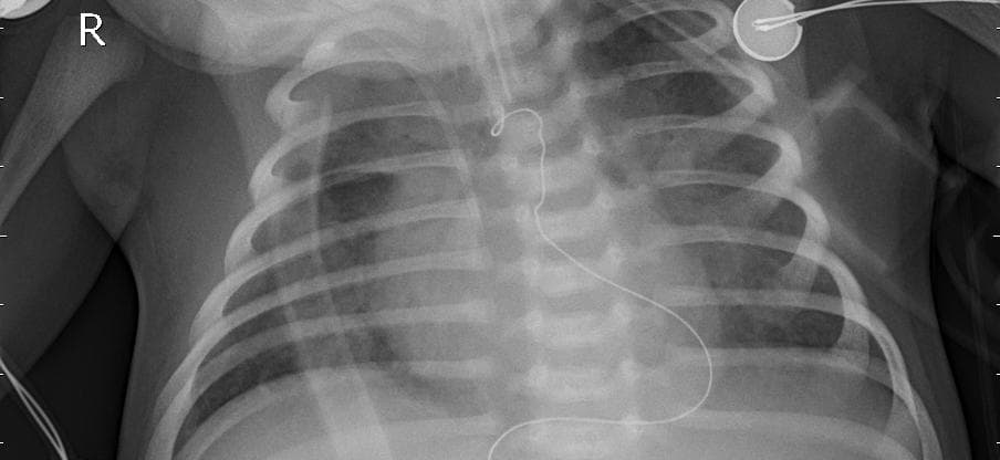 Pneumonia — NIH Chest X-ray14