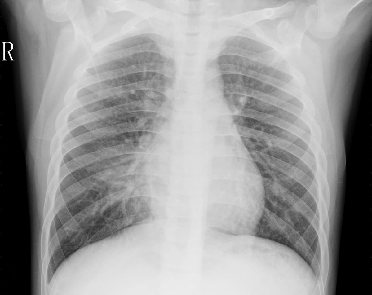 Pneumonia — NIH Chest X-ray14