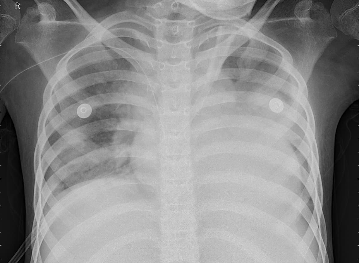 Pneumonia — NIH Chest X-ray14