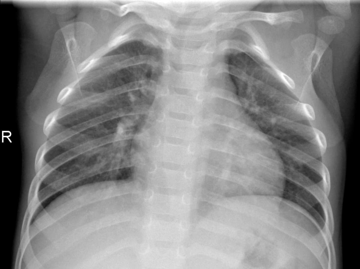 Radiografia Normal — NIH Chest X-ray14