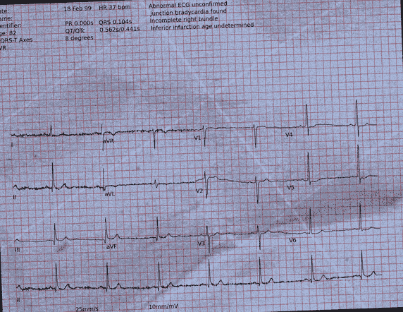 Normal ECG — PTB-XL
