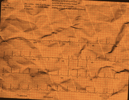 Normal ECG — PTB-XL