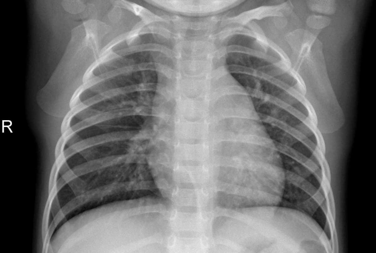 Pneumonia — NIH Chest X-ray14