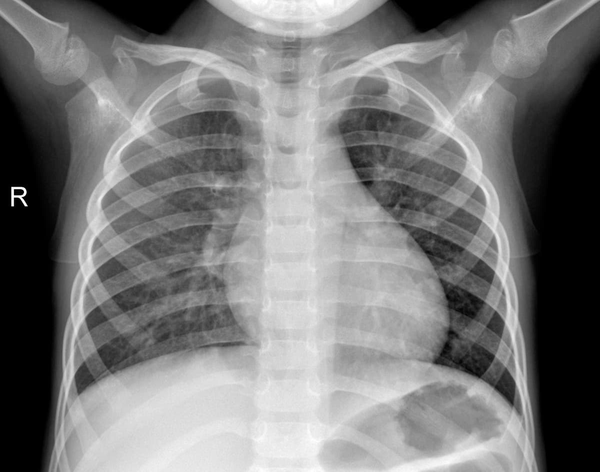 Radiografia Normal — NIH Chest X-ray14