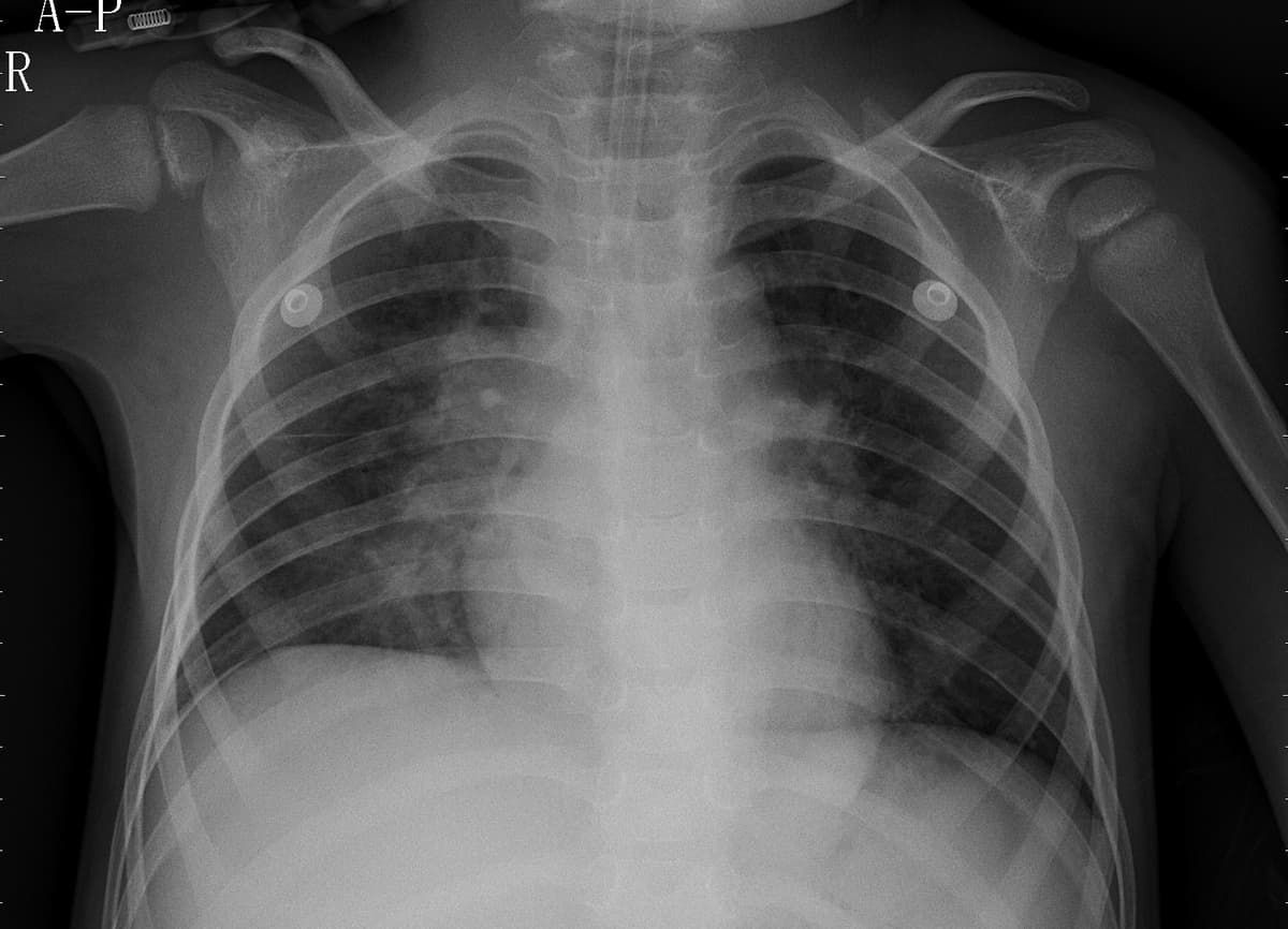 Pneumonia — NIH Chest X-ray14
