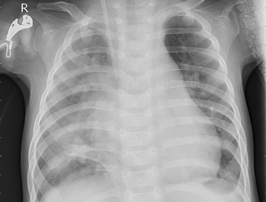 Pneumonia — NIH Chest X-ray14