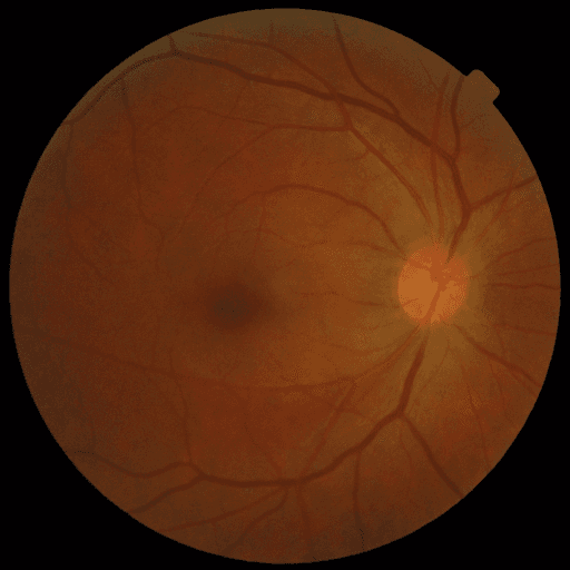 No Diabetic Retinopathy — MESSIDOR-2