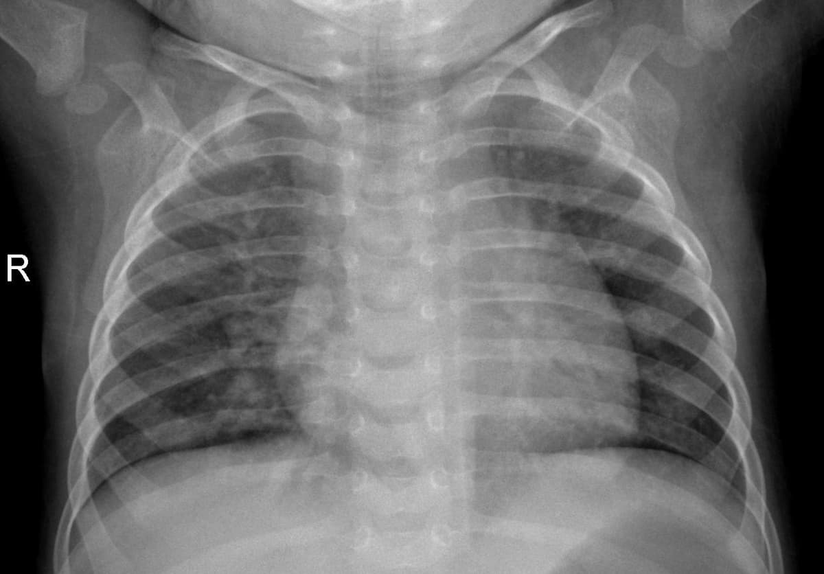 Pneumonia — NIH Chest X-ray14