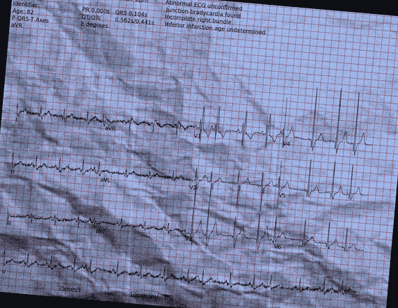Normal ECG — PTB-XL