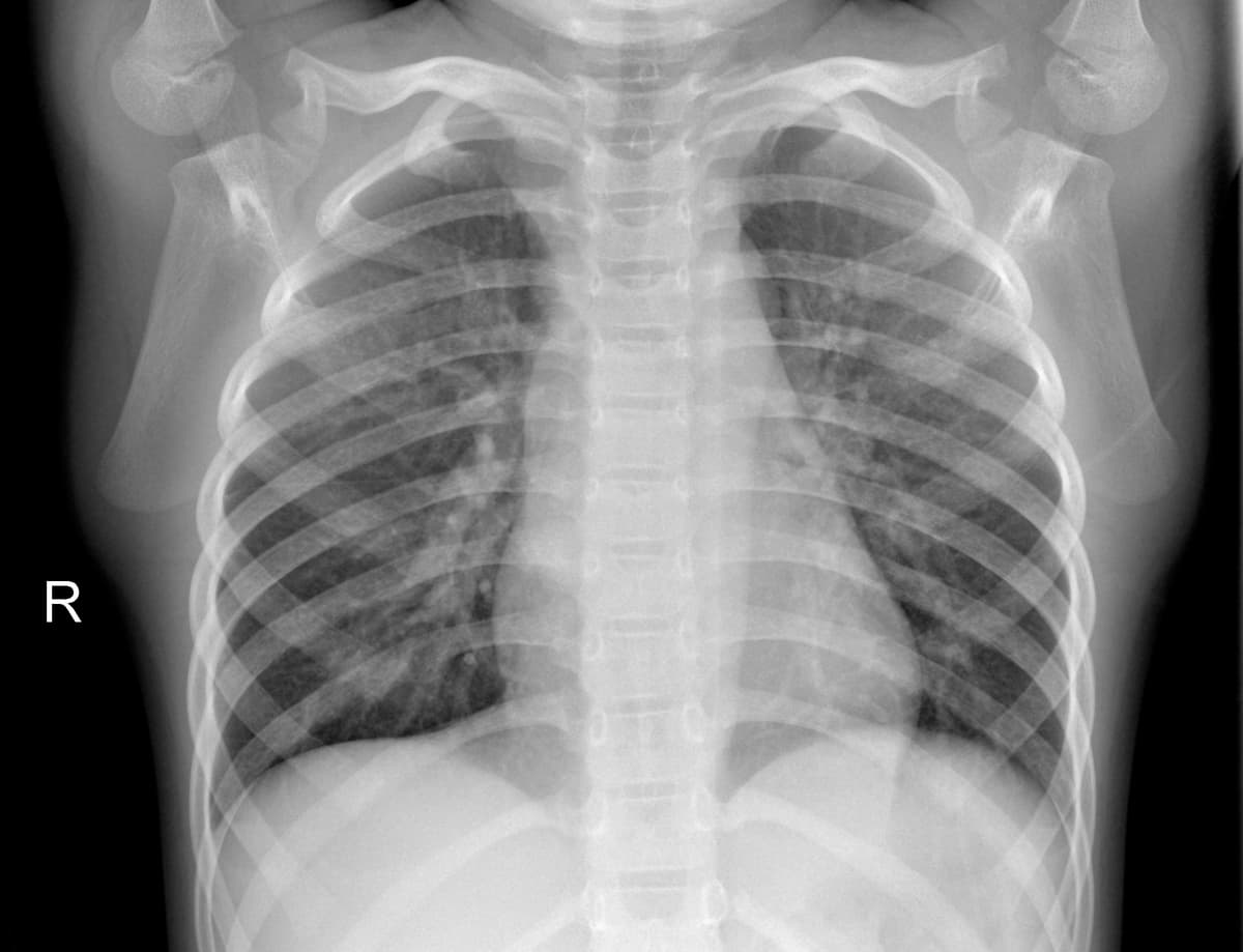 Radiografia Normal — NIH Chest X-ray14