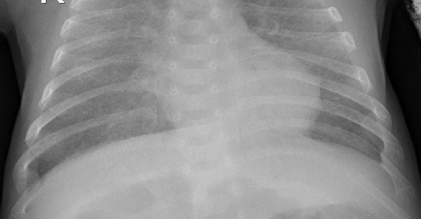 Pneumonia — NIH Chest X-ray14
