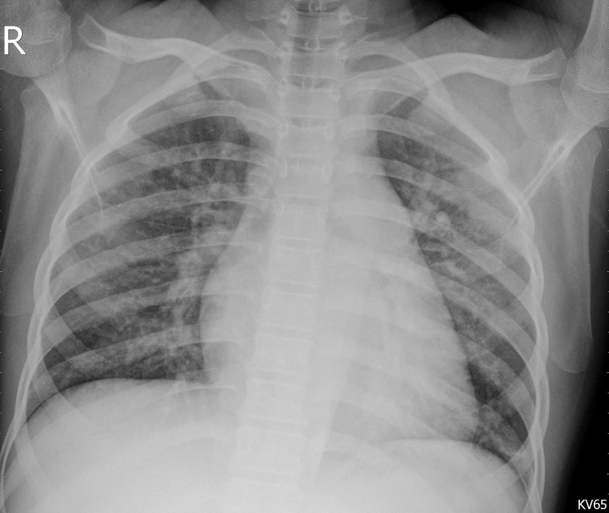 Pneumonia — NIH Chest X-ray14