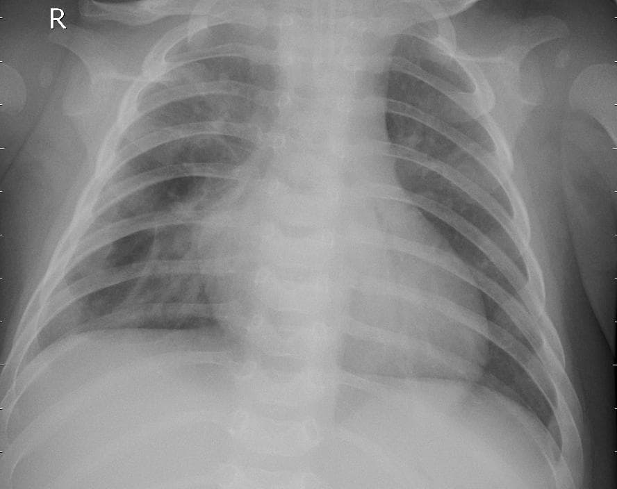 Pneumonia — NIH Chest X-ray14