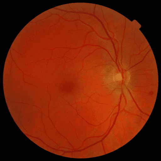 No Diabetic Retinopathy — MESSIDOR-2