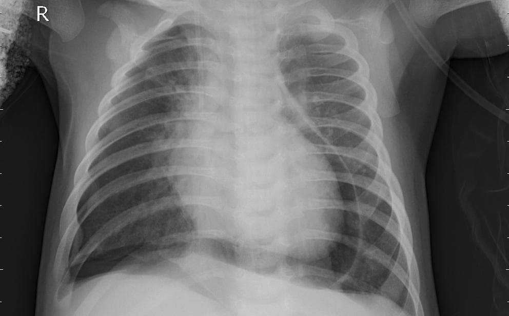 Pneumonia — NIH Chest X-ray14