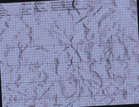 Normal ECG — PTB-XL