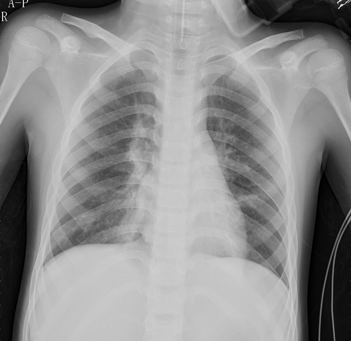 Pneumonia — NIH Chest X-ray14
