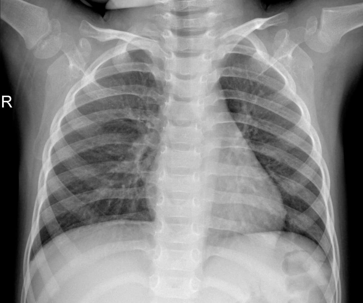 Radiografia Normal — NIH Chest X-ray14