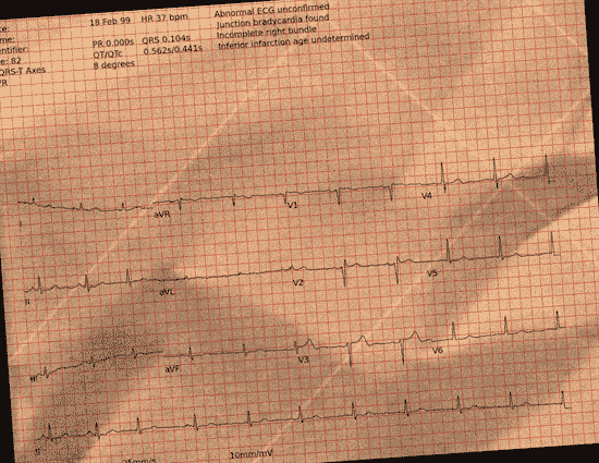 Normal ECG — PTB-XL