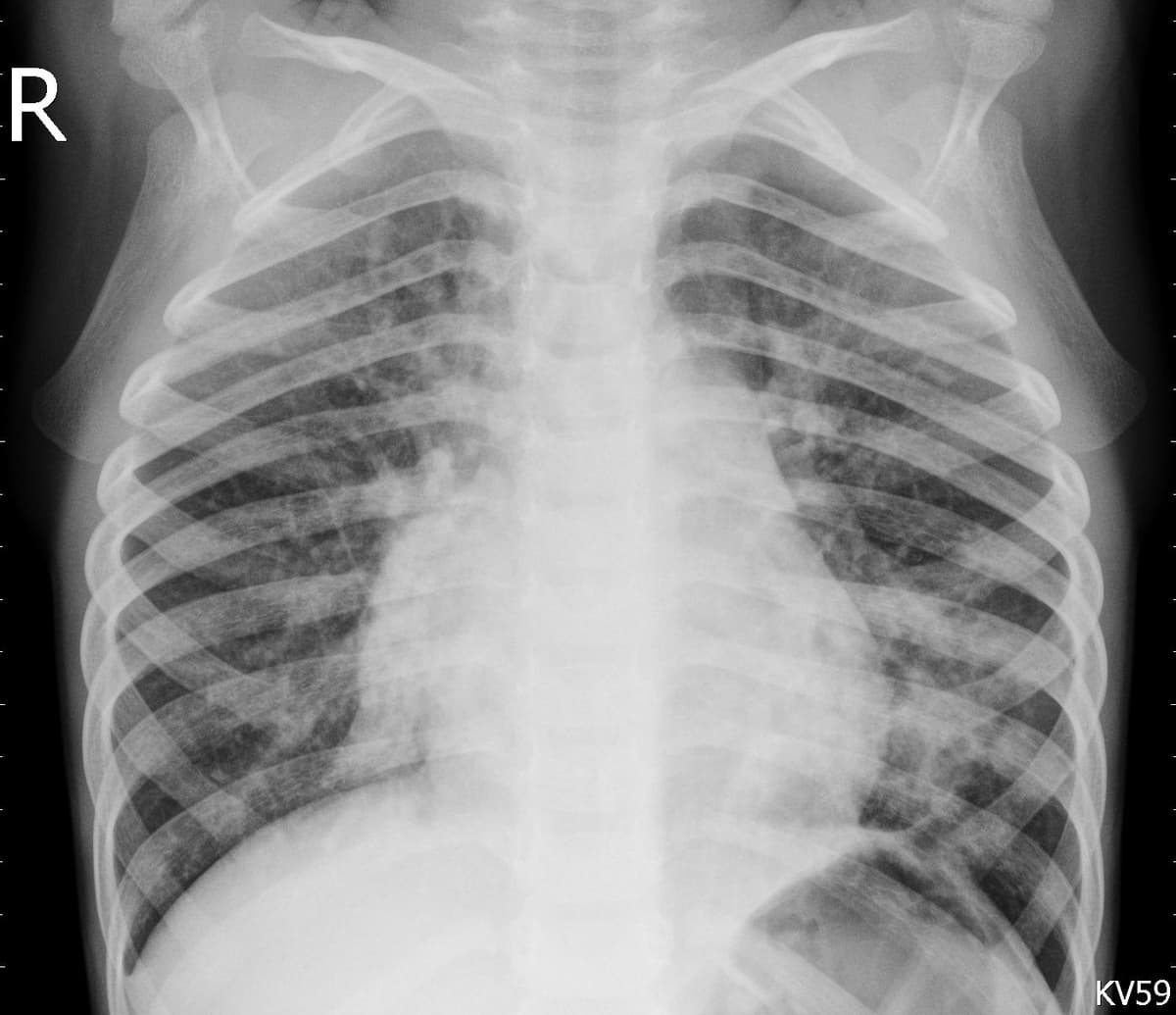 Pneumonia — NIH Chest X-ray14