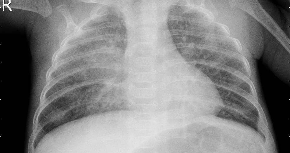 Pneumonia — NIH Chest X-ray14