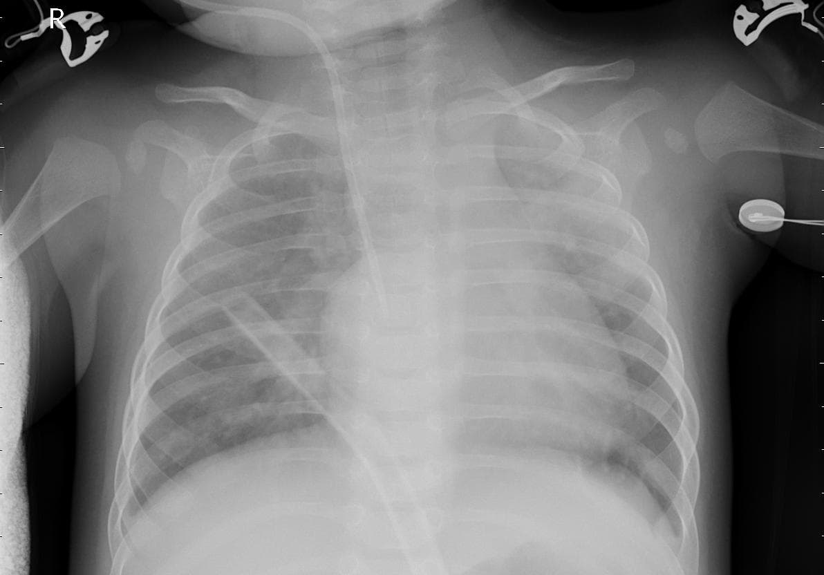 Pneumonia — NIH Chest X-ray14