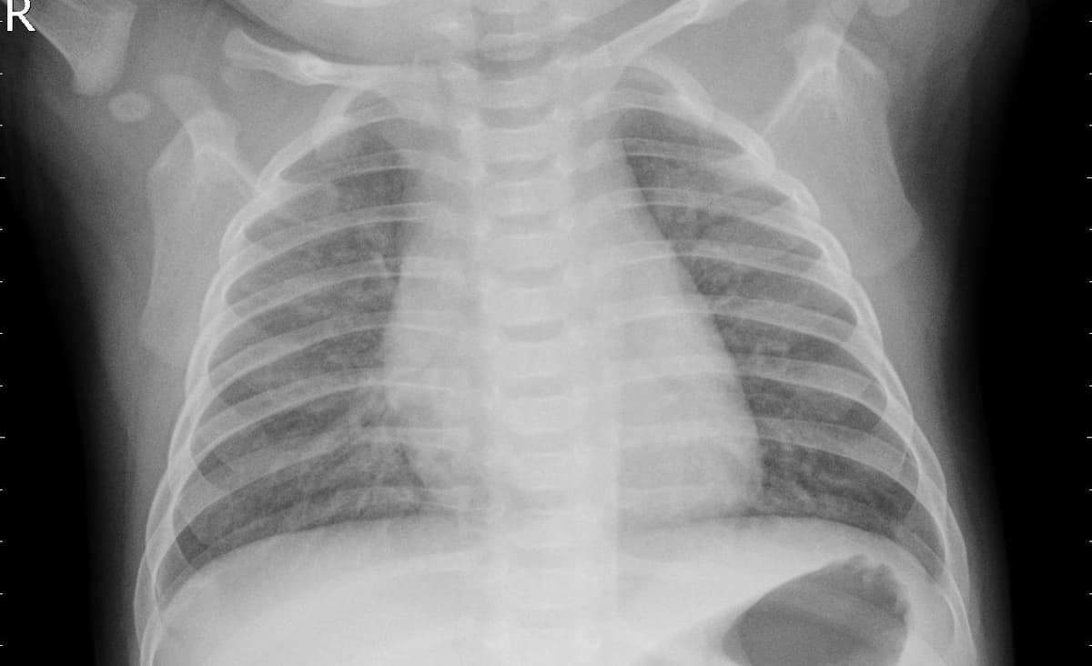 Pneumonia — NIH Chest X-ray14