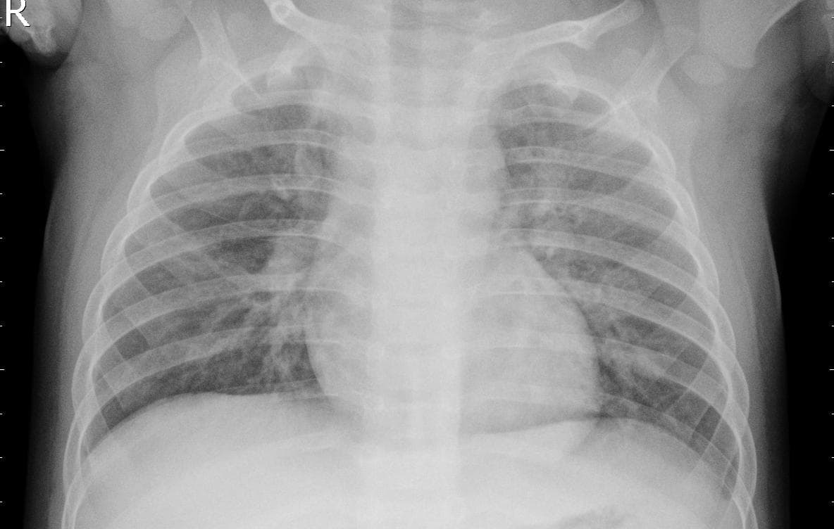 Pneumonia — NIH Chest X-ray14