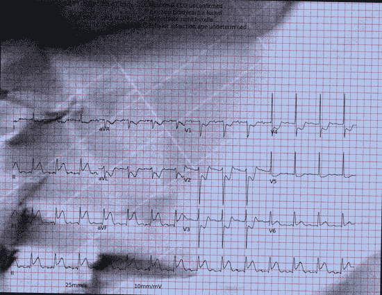 Normal ECG — PTB-XL